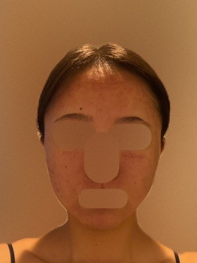 after photo: ダーマペン