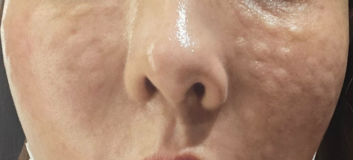 after photo: 스킨보톡스