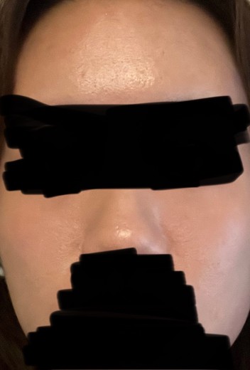 after photo: ダーマペン, ヴェルベットスキン