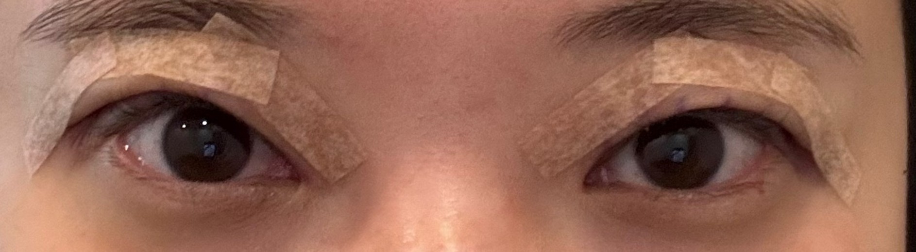 after photo: 눈재수술, 눈매교정