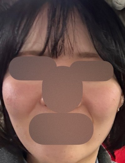 before photo: レーザートーニング