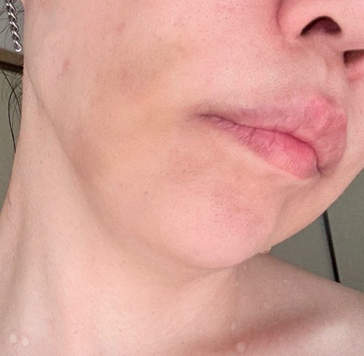 after photo: 脂肪溶解注射(顔)