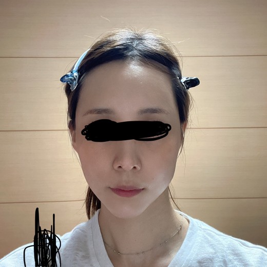 after photo: ジュベルック(Juvelook)