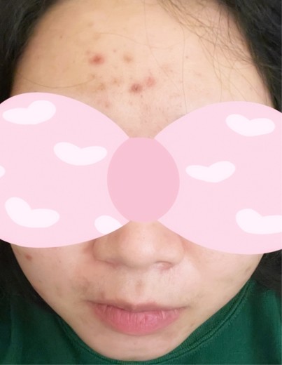 after photo: ジュベルック(Juvelook), サブシジョン(ニキビ跡治療)