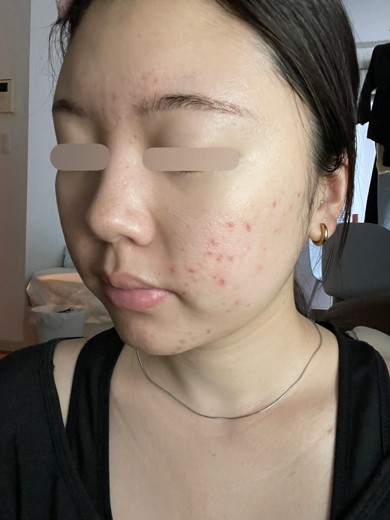 after photo: ピーリング, ララピール(LHAピーリング)