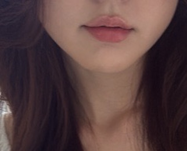 after photo: 윤곽주사, 사각턱보톡스