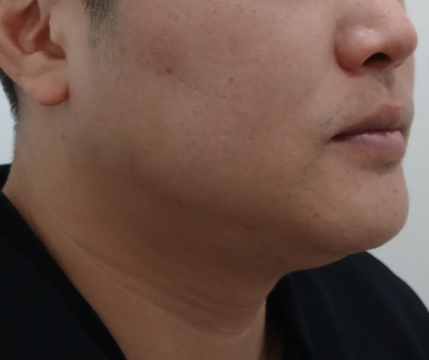 before photo: 울쎄라리프팅