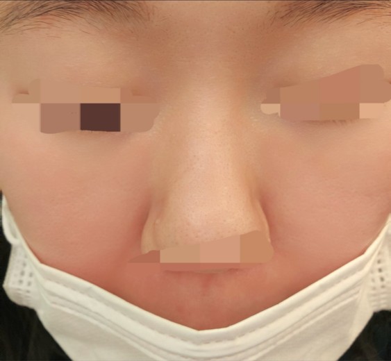 after photo: 아쿠아필링