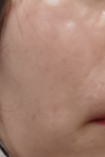 after photo: IPL(光/フォト治療)