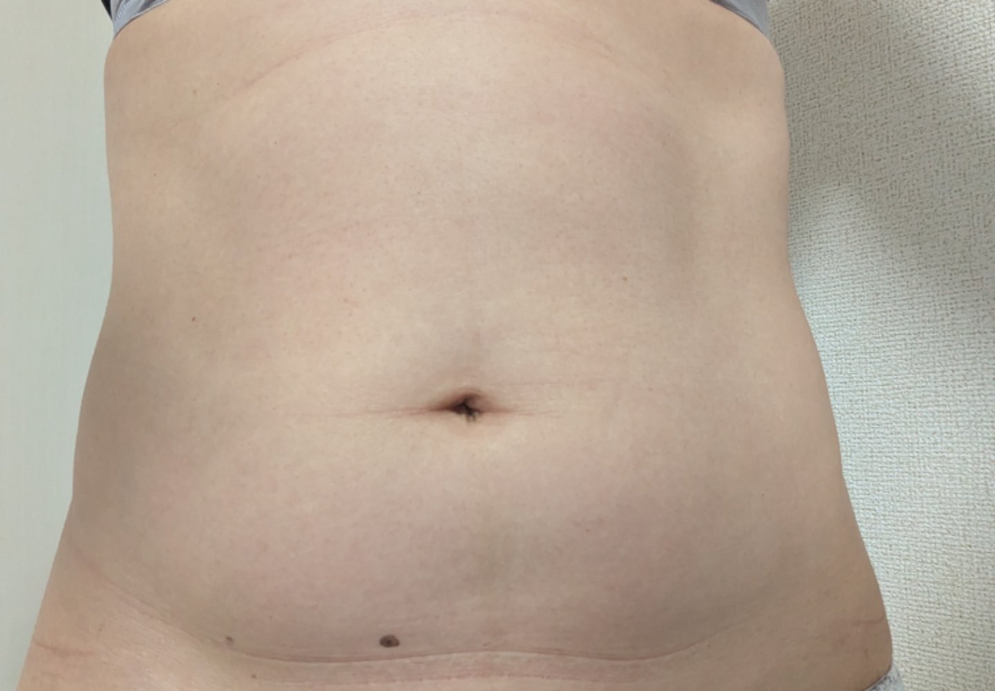 スノエル（脂肪冷却）2パーツ4ハンドル 部分痩せしたい方◎ | オルタ