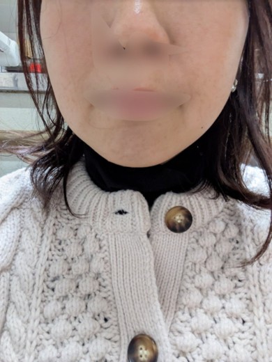 after photo: 脂肪溶解注射(顔)