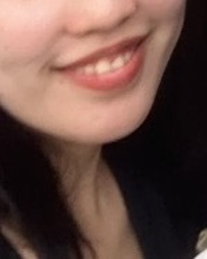 before photo: 脂肪溶解注射(顔)