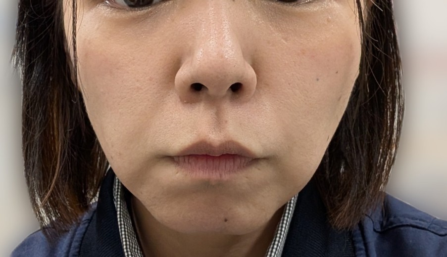 after photo: ハイフ(HIFU)