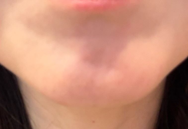 after photo: 美容注射・点滴