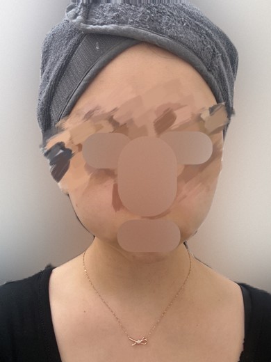 before photo: 온다리프팅