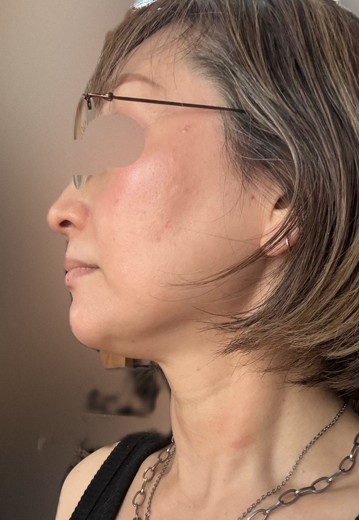 after photo: リニアファーム(ハイフ)