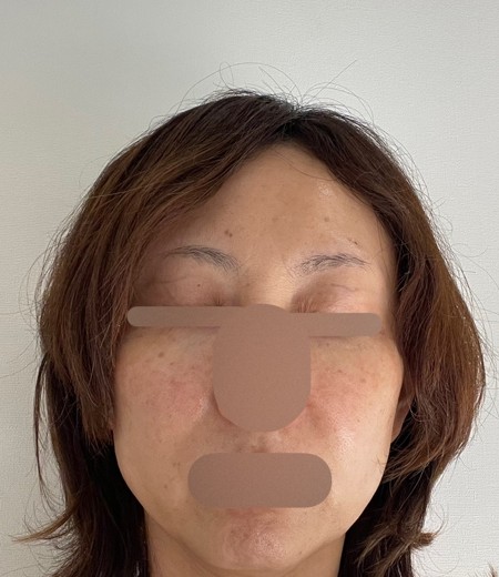 before photo: ハイフ(HIFU)