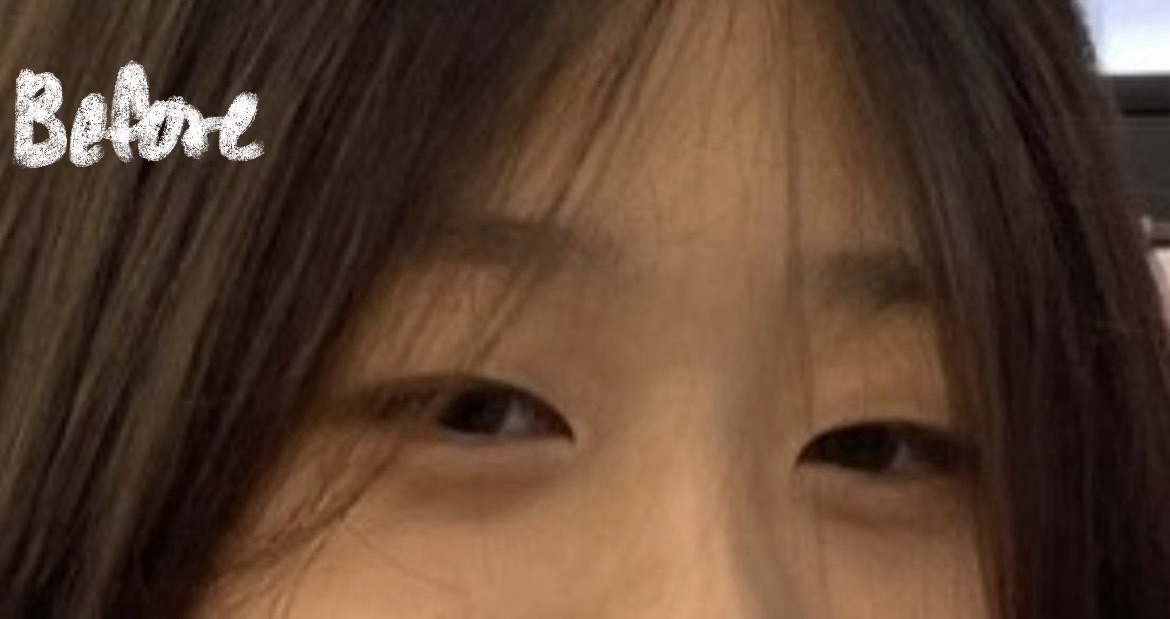 시술 전