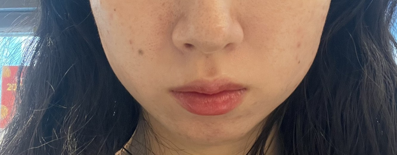 before photo: 사각턱보톡스