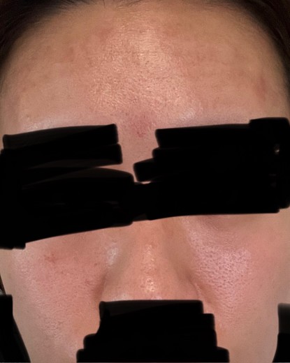 after photo: ダーマペン, ヴェルベットスキン