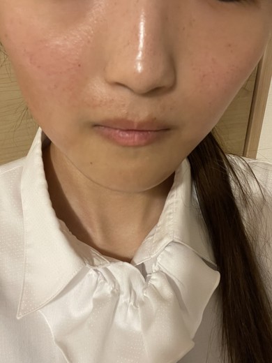 after photo: ピーリング, ルメッカ