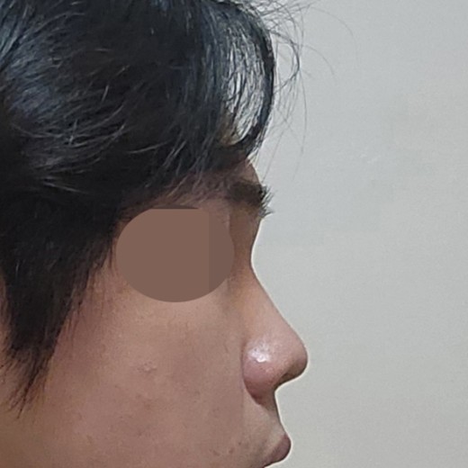 before photo: 코끝(자가연골)