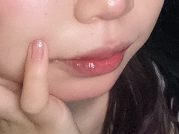 限定価格】たらこ唇修正 | PRISM Beauty Clinic 町田院 / プリズム