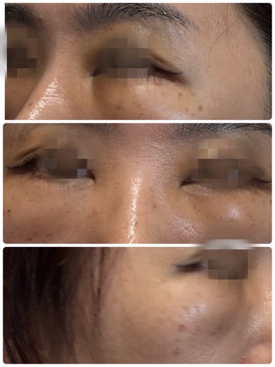 after photo: 目の下の脂肪注入(クマ治療)