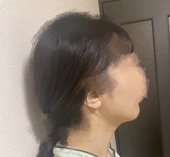 after photo: チタニウムリフト