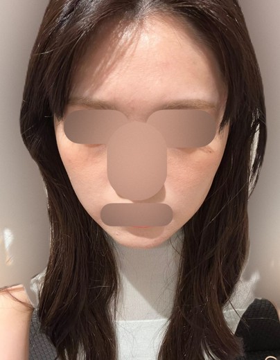 before photo: 額のしわボトックス