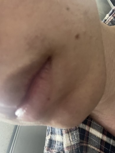 after photo: 턱제모, 인중제모