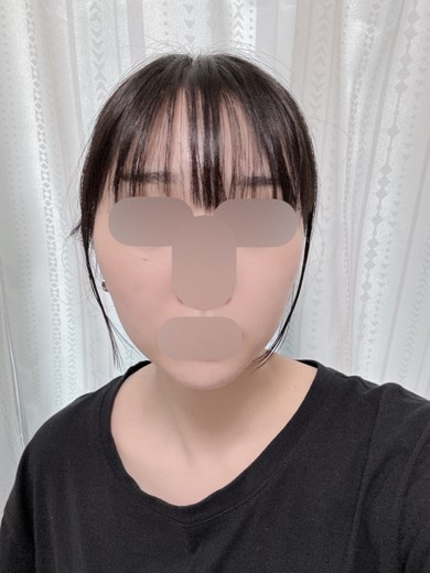 after photo: 脂肪溶解注射(顔)