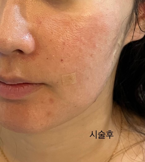 after photo: 리쥬란힐러