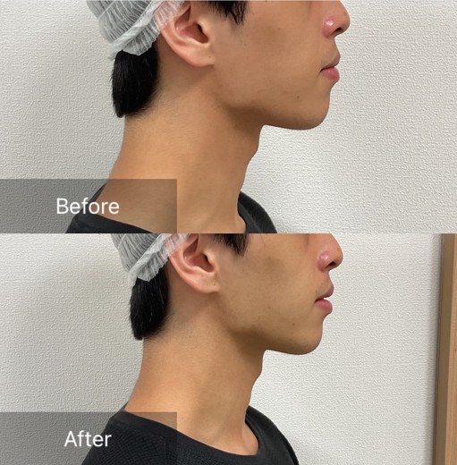 after photo: チタニウムリフト