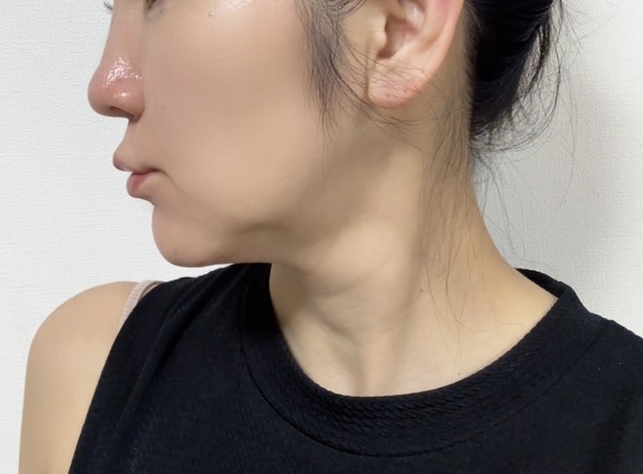 after photo: チタニウムリフト