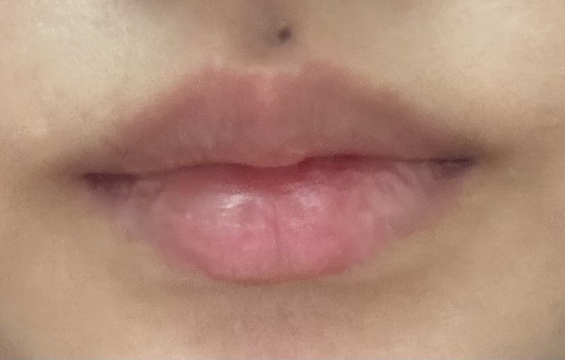 before photo: 입술필러