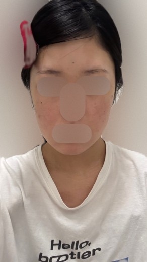 before photo: イオン導入