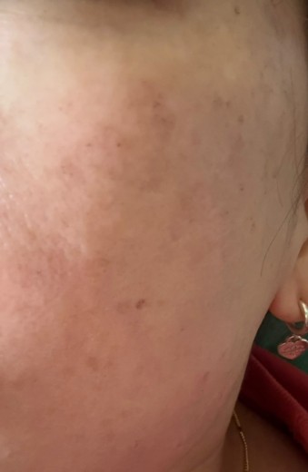 after photo: エレクトロポレーション, ルメッカ