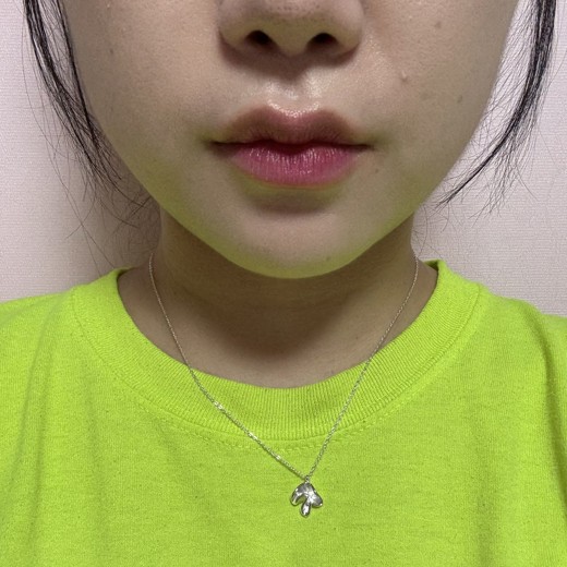 after photo: 사각턱보톡스