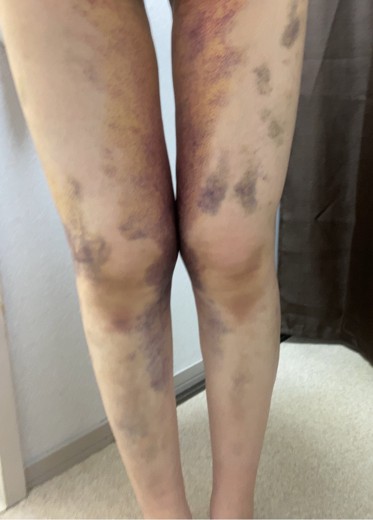 after photo: 豊胸(脂肪注入)