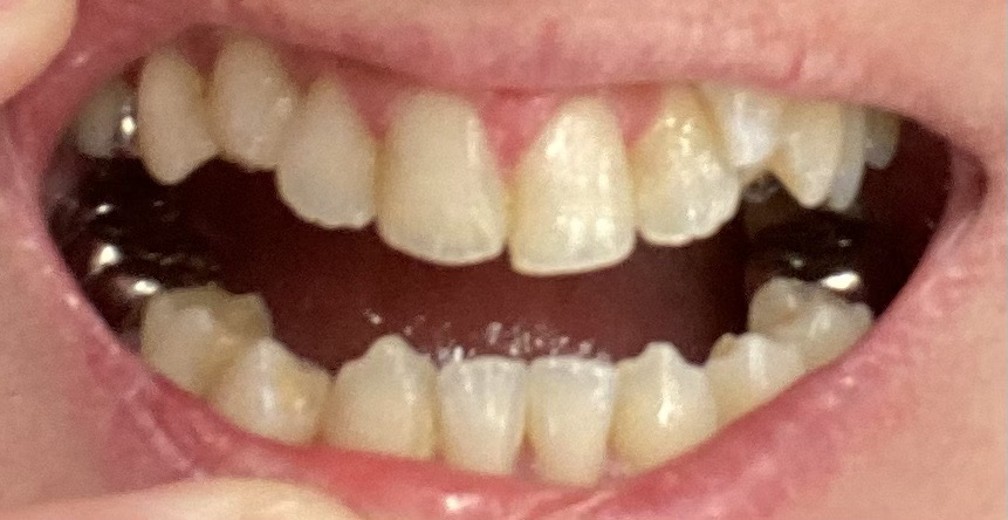 before photo: ホワイトニング