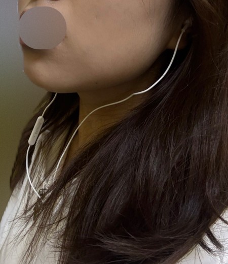 after photo: 윤곽주사, 얼굴지방분해주사