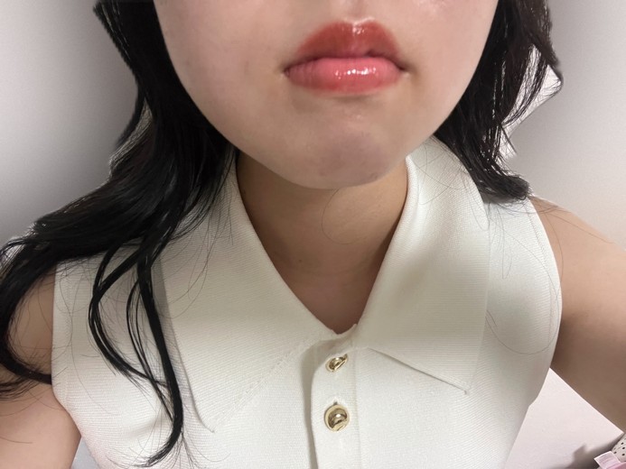 before photo: インモード