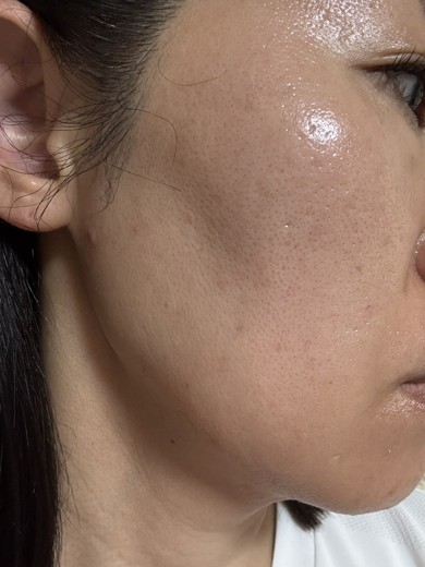 after photo: IPL(光/フォト治療)