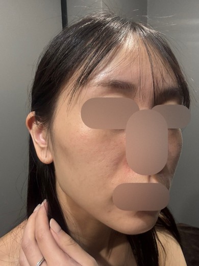 before photo: ルメッカ