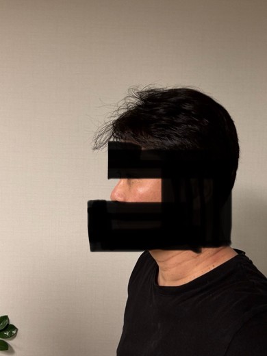 after photo: 눈밑지방재배치