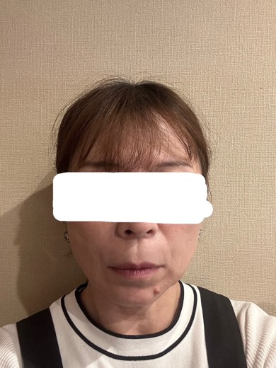 after photo: ハイフ(HIFU)