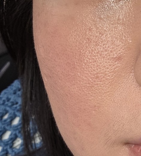 before photo: 리쥬란힐러, 쥬베룩