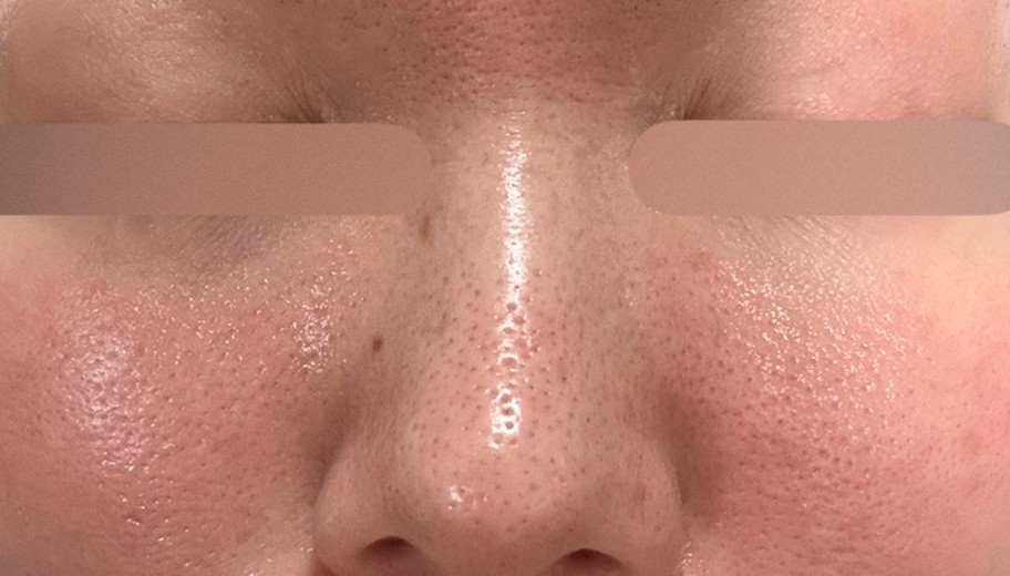 before photo: ダーマペン