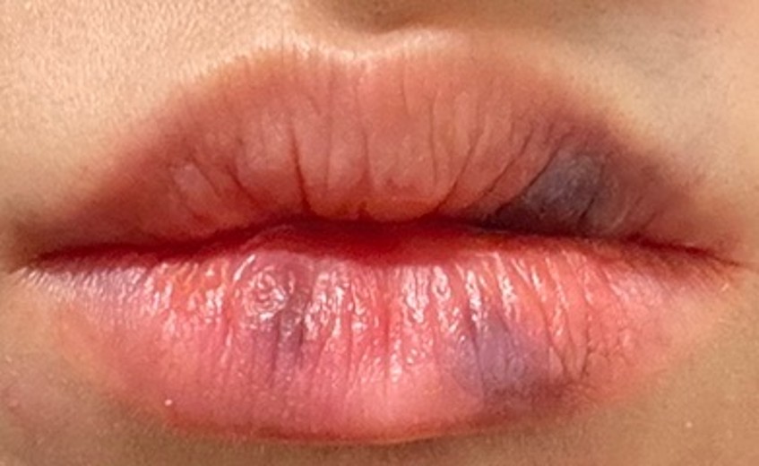 after photo: 필러제거주사